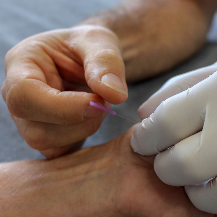 Dry needling behandeling met naald
